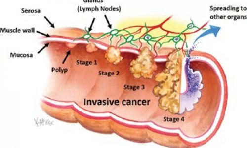 Tuổi nào nên đi xét ngiệm ung thư ruột ?