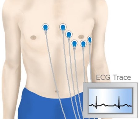 Mỗi ngày có khoảng 120 người Úc tử vong vì bệnh tim mạch - Tại sao nên chạy Điện Tâm Đồ (ECG) ngay khi còn trẻ?