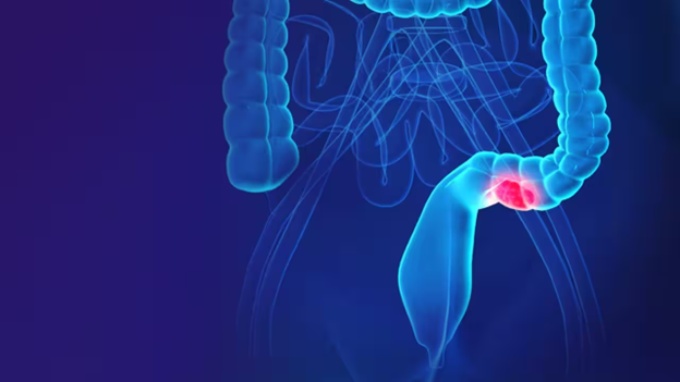 Sức khỏe là Vàng: Từ polyp đến ung thư – bác sĩ cảnh báo điều nhiều người trẻ đang bỏ qua