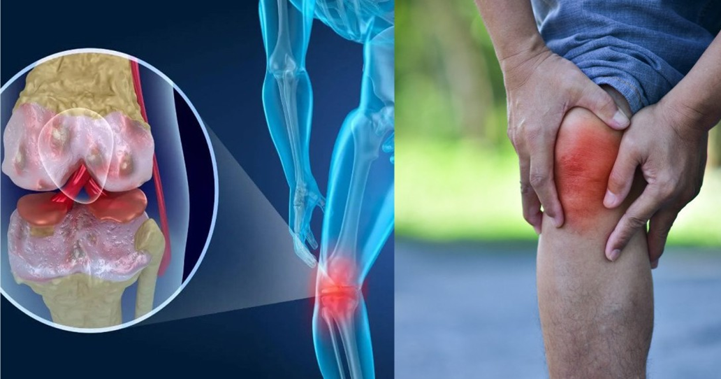 Mùa Đông: Người cao tuổi thường hay đau khớp gối - Nên làm gì để phòng ngừa và điều trị cho bớt lo lắng?