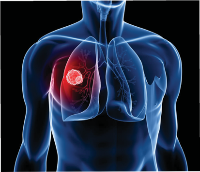 Ung thư phổi tại Úc: - Mỗi năm 15,500 người được chẩn đoán mắc bệnh, gần 9,000 ca tử vong.